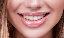 Wybielanie zębów w domu - czy jest skuteczne? Przegląd najpopularniejszych metod