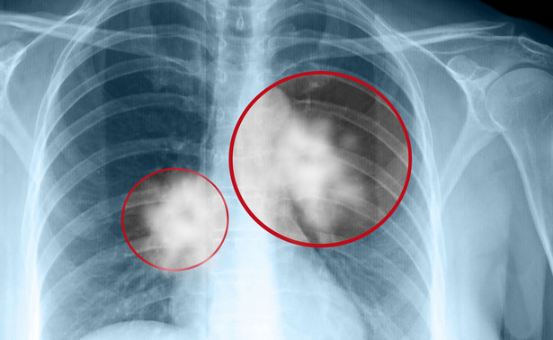 Rewolucja w leczeniu raka? "Czterokrotnie zwiększa przeżywalność"