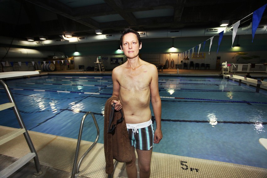 Džodi na mestu gde su nekada bile bradavice ima dva ožiljka