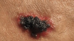 Taking this pain reliever can cause melanoma in men