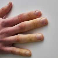 Kifejezetten érzékenyek az ujjai a hidegre? Erről a betegségről jobb ha tud