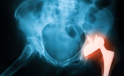 Ortopeda: Wymiana implantu biodra to dziś operacja jednego dnia. WYWIAD