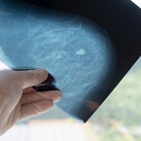 Emlőciszta vagy tumor okozza a csomót a mellben? Ez a vizsgálat segít tisztázni