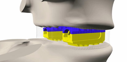 Mam implant wielkości klocka Lego!