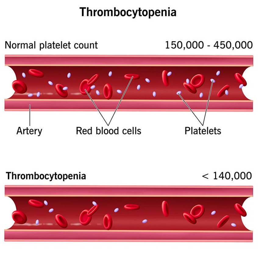Normalan nivo trombocita kod odraslih je od 150.000 do 450.000 po mikrolitru krvi