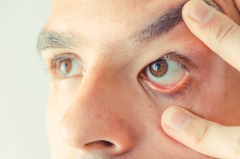 Retinoblastoma