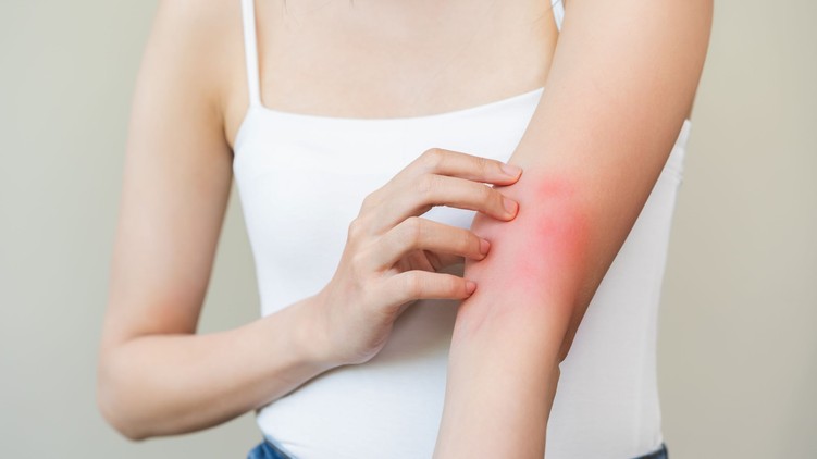 ekcéma atópiás dermatitisz életminőség alvás