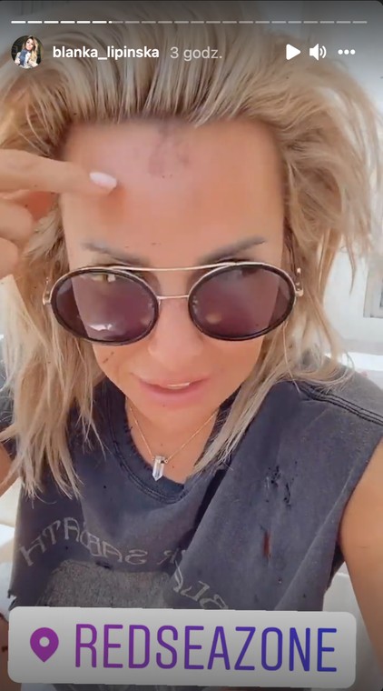 Blanka Lipinska muestra sus heridas tras el accidente