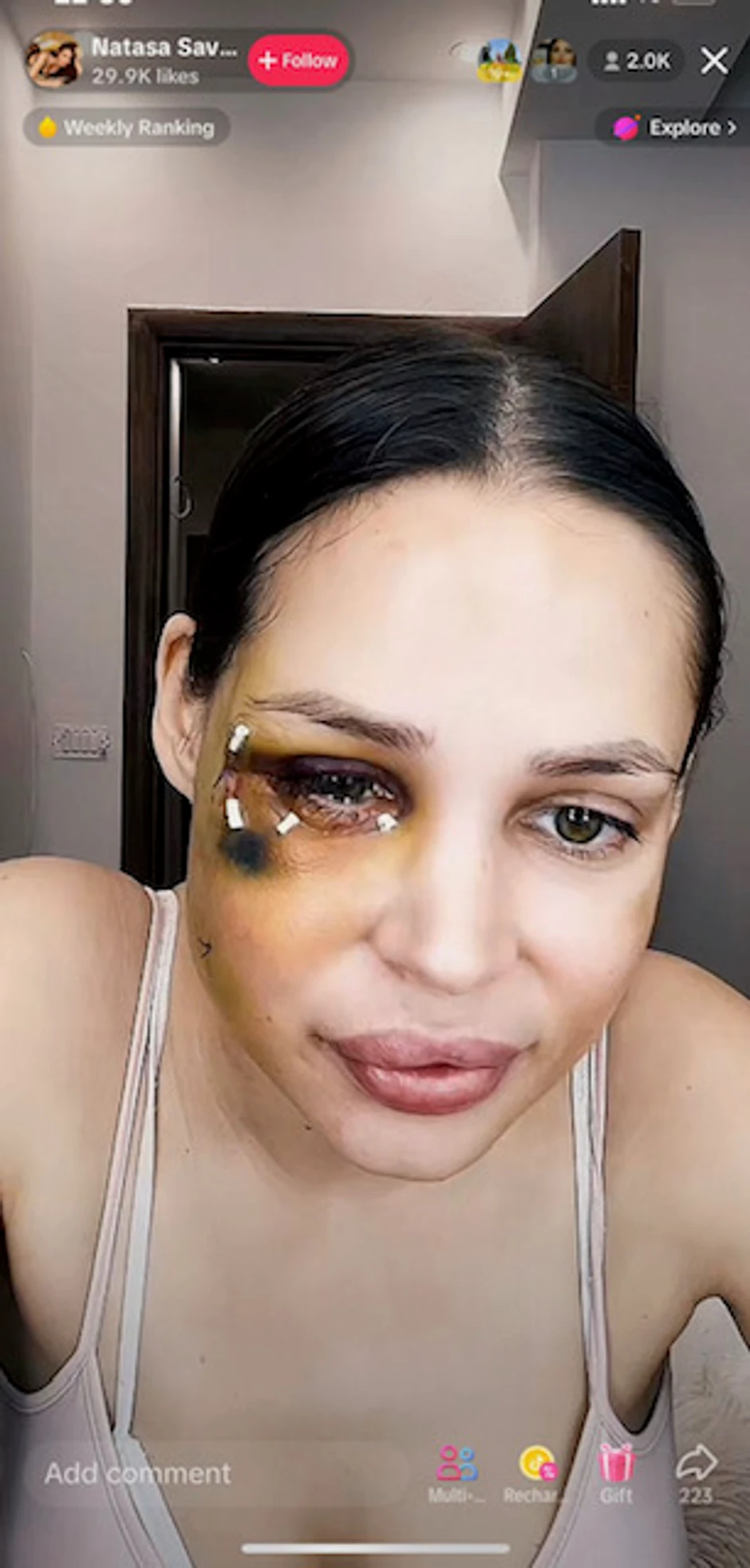 Šavija posle druge operacije