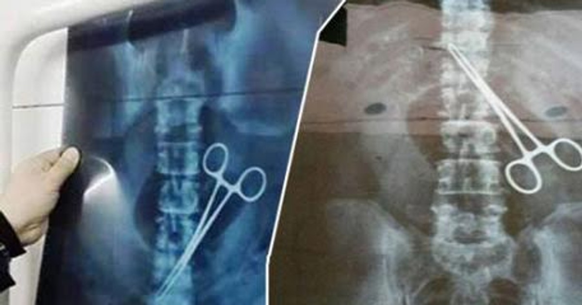 Xray reveals scissors in belly of Nigerian Pilgrim Pulse Nigeria