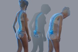 Posledice osteoporoze na ženskom telu