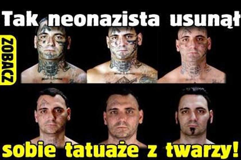 Tak neonazista usunął sobie tatuaże z twarzy! Zobacz