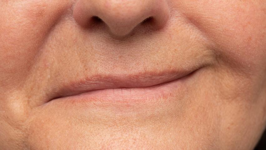 lefelé görbül száj jele arcidegbénulás korai tünet