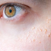 Mik azok a kis, fehér, kidudorodó pöttyök a bőrön?