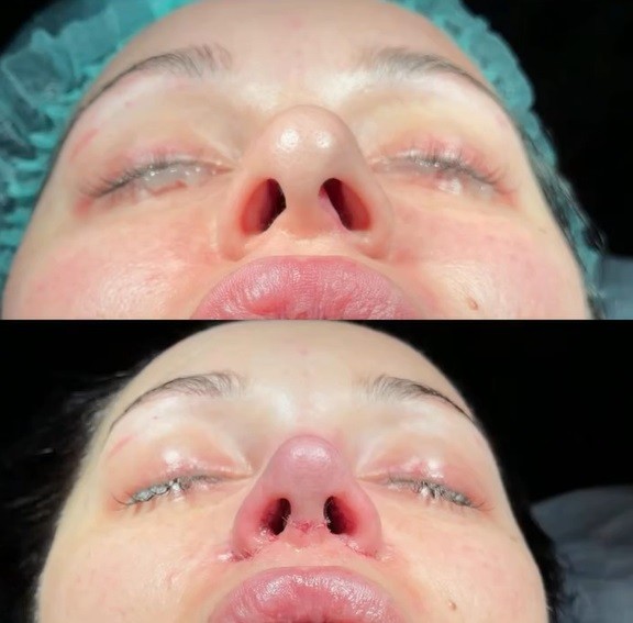 Influencerka Bianka Rumanová ukázala výsledky operácie, ktorú podstúpila v Turecku. 