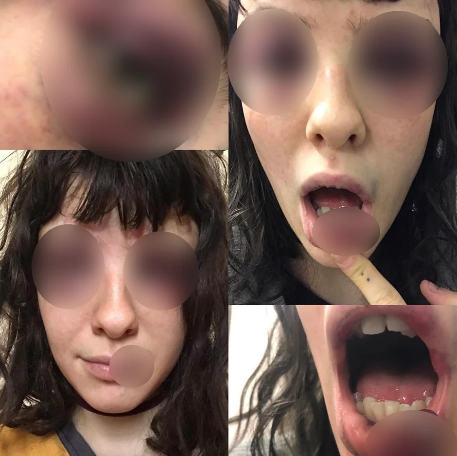 Pretučena devojka objavila je fotografije na mrežama