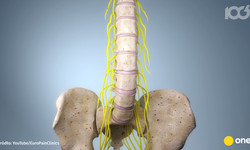 Paraliżujący ból pleców, który może skończyć się operacją