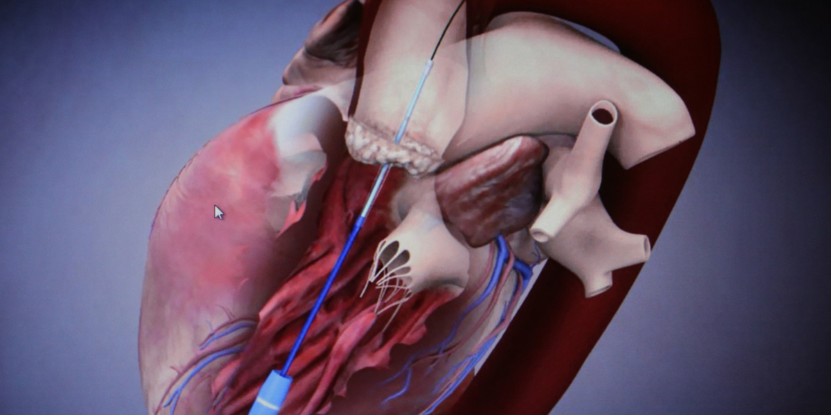 wszczepienie zastawki aorty