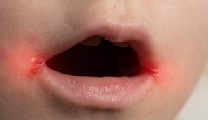 Impetigo na licu najpre počinje oko usta i nosa
