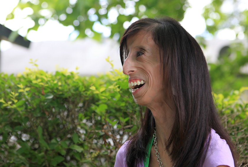  Lizzie Velasquez