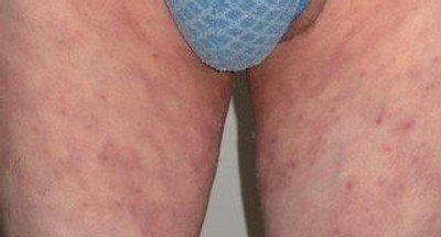 Grzybica Pachwin Przyczyny Objawy Diagnostyka Leczenie Zapobieganie