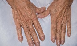 Palce pałeczkowate to nietypowy objaw raka płuc i chorób wątroby. Zwróć uwagę na kształt paznokci