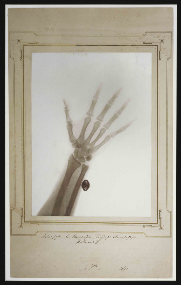 Prześwietlenie ręki i nadgarstka cara Mikołaja II pochodzące z 1898 r. Wg wielu zdjęcie wykonano nie z powodu urazu, ale fascynacji nauką i nowymi odkryciami oraz rozwojem technologicznym