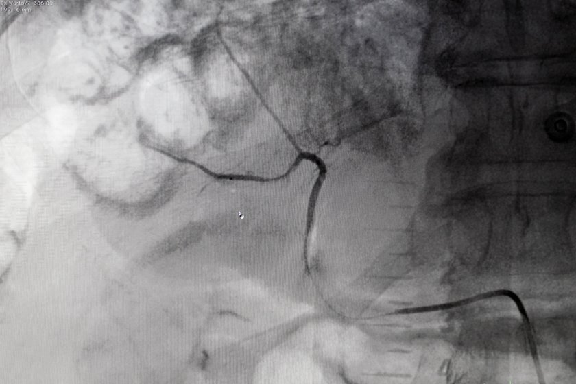 Chemoembolizacja guza wątroby. Tak leczą w Bytomiu!