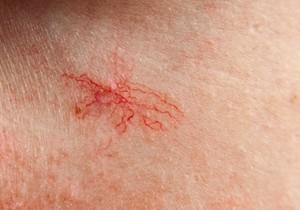 Ovi crveni, plavi ili ljubičasti klasteri koji izgledaju kao paukova mreža, pojavljuju se duž obraza i nosa