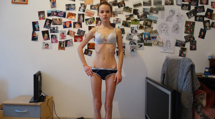 Anorexiás tini / Fotó: Northfoto