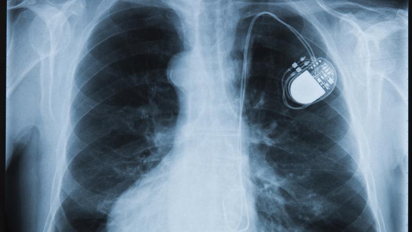 pacemaker, defibrillátor beültetése mikorszükséges