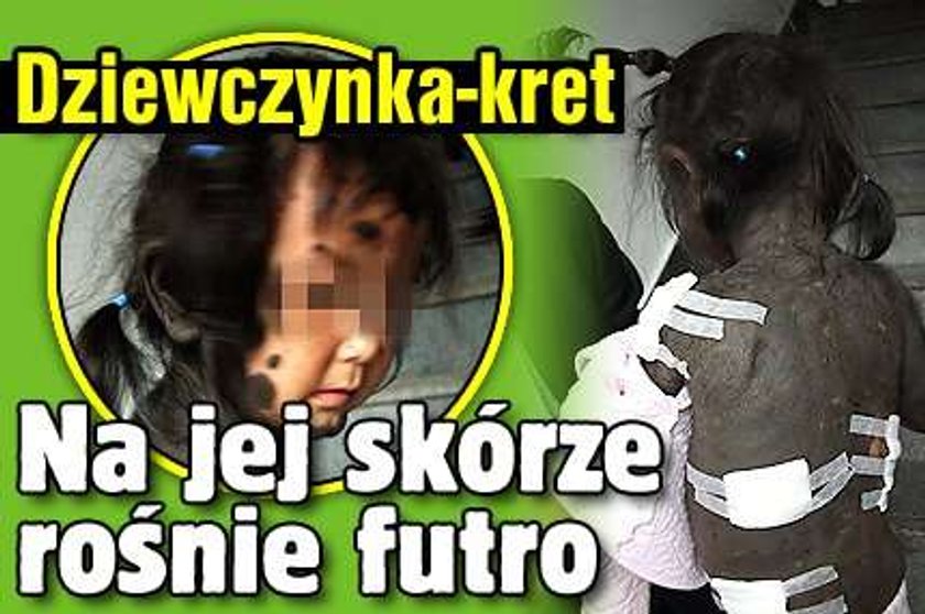 Dziewczynka-kret. Na jej skórze rośnie futro