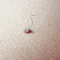 Szőrszál az anyajegyben - itt a válasz arra, hogy rákot okozhat-e az, ha kihúzza belőle
