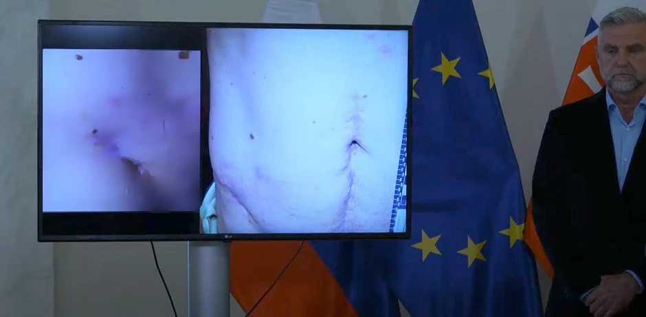 Stomak Roberta Fica nakon atentata i operacija