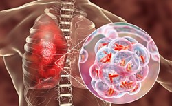 Legionelloza - choroba brudnych instalacji i zaniedbanych fontann. To trzeba wiedzieć!