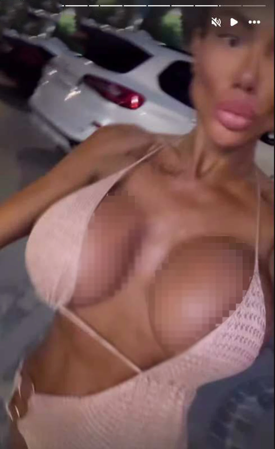 Straleta izvadila silikone, pa ih vratila i izazvala reakcije zbog prenaglašenih oblina: "Imala sam 100 operacija"