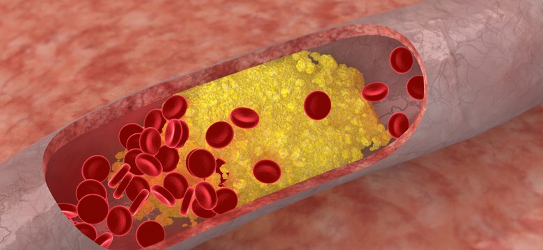 Hipercholesterolemia rodzinna to tykająca bomba. Jak ją wykryć?