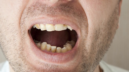 Jak pozbyć się kamienia na zębach? Zalecenia od dentystki