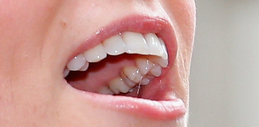 Oj! Co księżna Kate ma na zębach?
