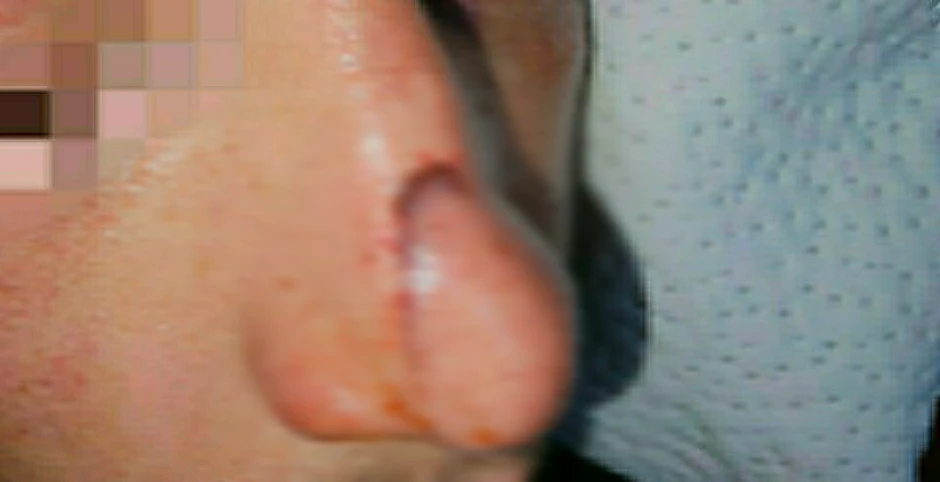 Povrede nosa i lica nakon pada sa trotineta