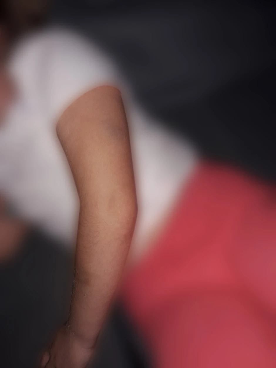 Modrice koje je devojčica zadobila