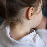 Újra járványokat okoz a régi betegség