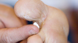 Jak leczyć grzybicę skóry? Poznaj domowe sposoby