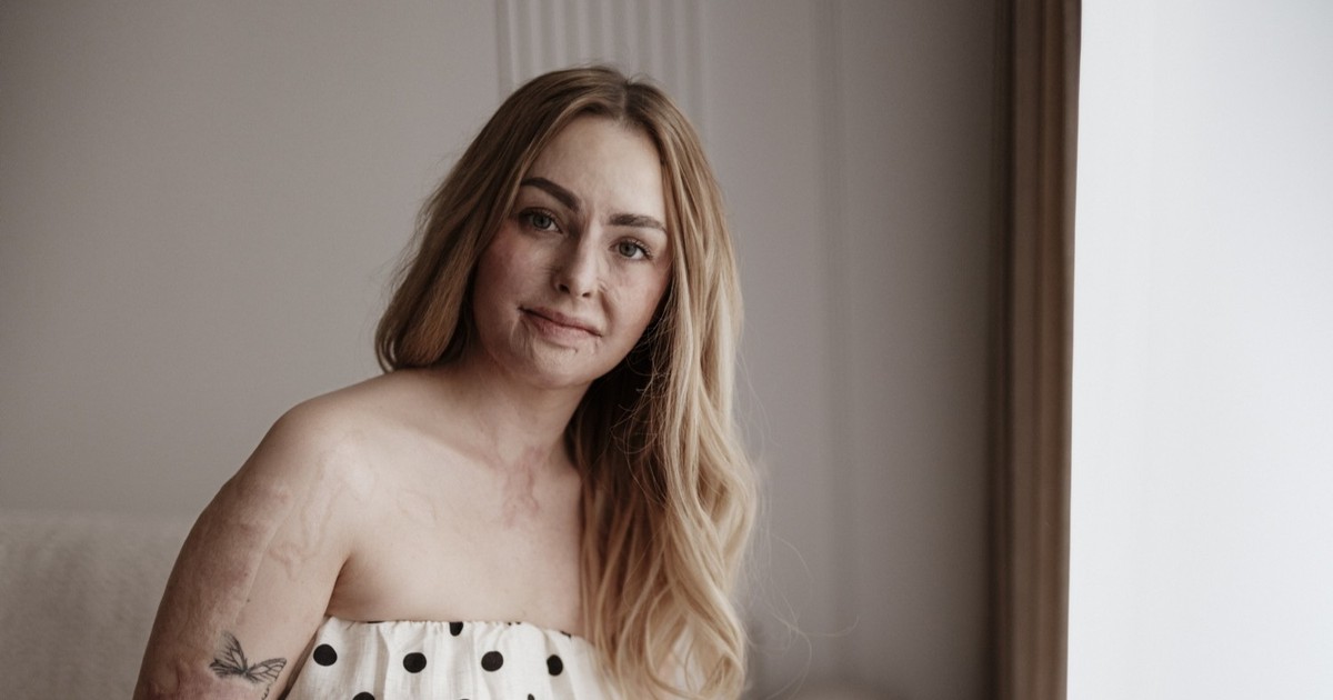 Żyją po potwornych poparzeniach. Maja bała się, iż jej twarz przestraszy choćby terapeutkę