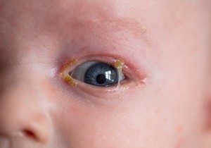 Lepljive oči se javljaju zbog nakupljenog isedka iz oka
