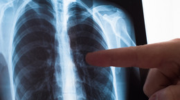 Specjaliści alarmują: podczas pandemii niemal zaprzestaliśmy diagnozowania raka płuca