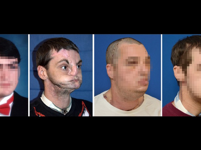 Ovo mu je ostalo od lica nakon pucanja u glavu: Posle transplantacije izgleda neverovatno