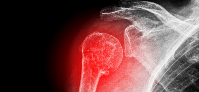 Osteoporoza to "cicha złodziejka kości" - jak się przed nią obronić?