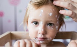 Wysypka i gorączka… Czy to może być ospa wietrzna? [OBJAWY]
