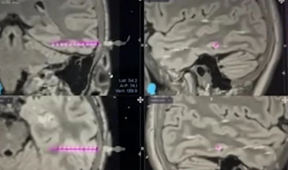 Elektrode ulaze u najdublje delove mozga